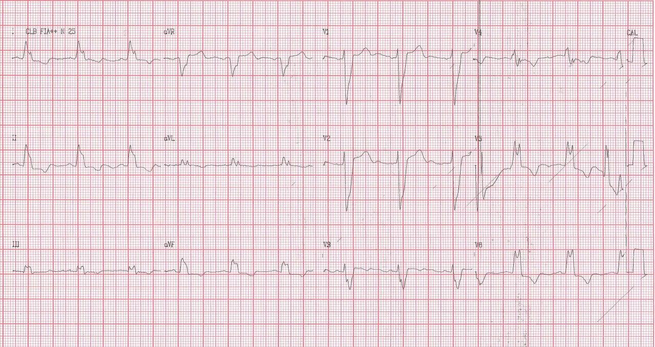 Mujer de 66 años con antecedentes de cirugía de revascularización previa que presenta angina inestable, con hallazgo de BCRI y FAP (fuerzas anteriores prominentes) por necrosis septal