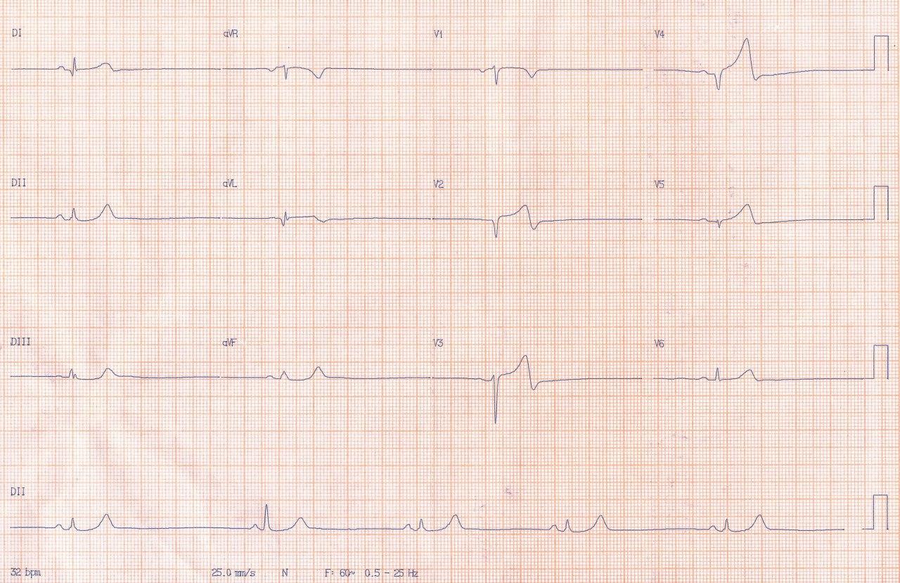 ECG correspondiente a paciente tratado con beta bloqueantes con cuadro de angor de reciente comienzo y episodio de angor de reposo actual que presenta subocluisón con trombo en Cx
