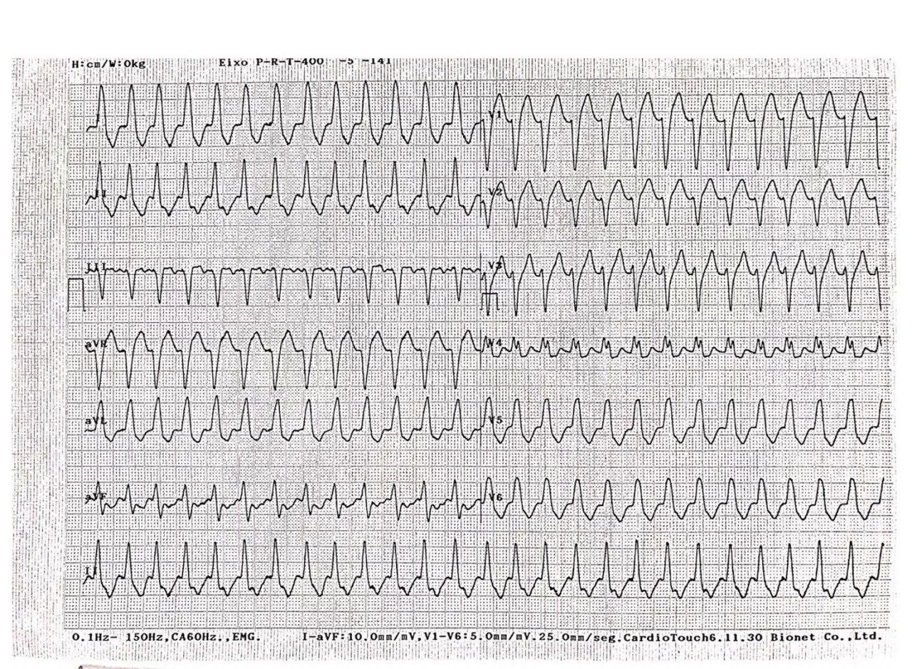 Paciente de 77 años, HTA, en diálisis crónica que presenta angor y disnea cuyo ECG muestra una taquicardia auricular con aberrancia