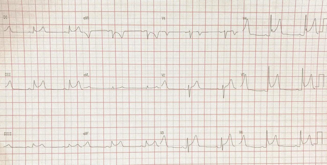 Hombre de 53 años con precordialgia atípica y troponina negativa que presenta imagen ECG de infradesnivel de PR con depresiónl ST en aVR correspondiente a repolarización precoz con elevación del segmento ST (ERSTE)