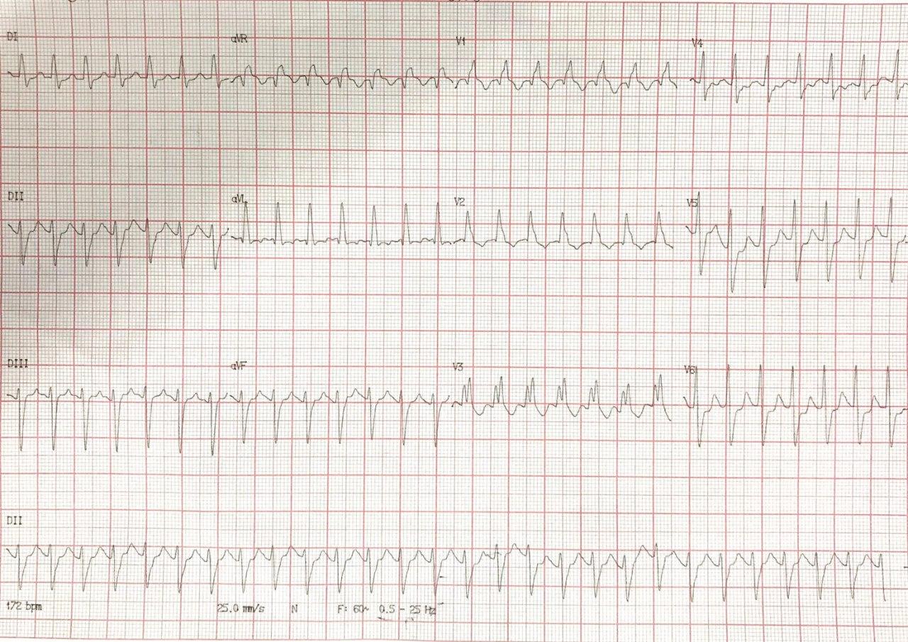 Hombre de 65 años con factores de riesgo que se sabe portador de trastorno de conducción y que presenta palpitaciones desde hace 48 horas por presencia de TPSV con aberrancia que se controla con amiodarona