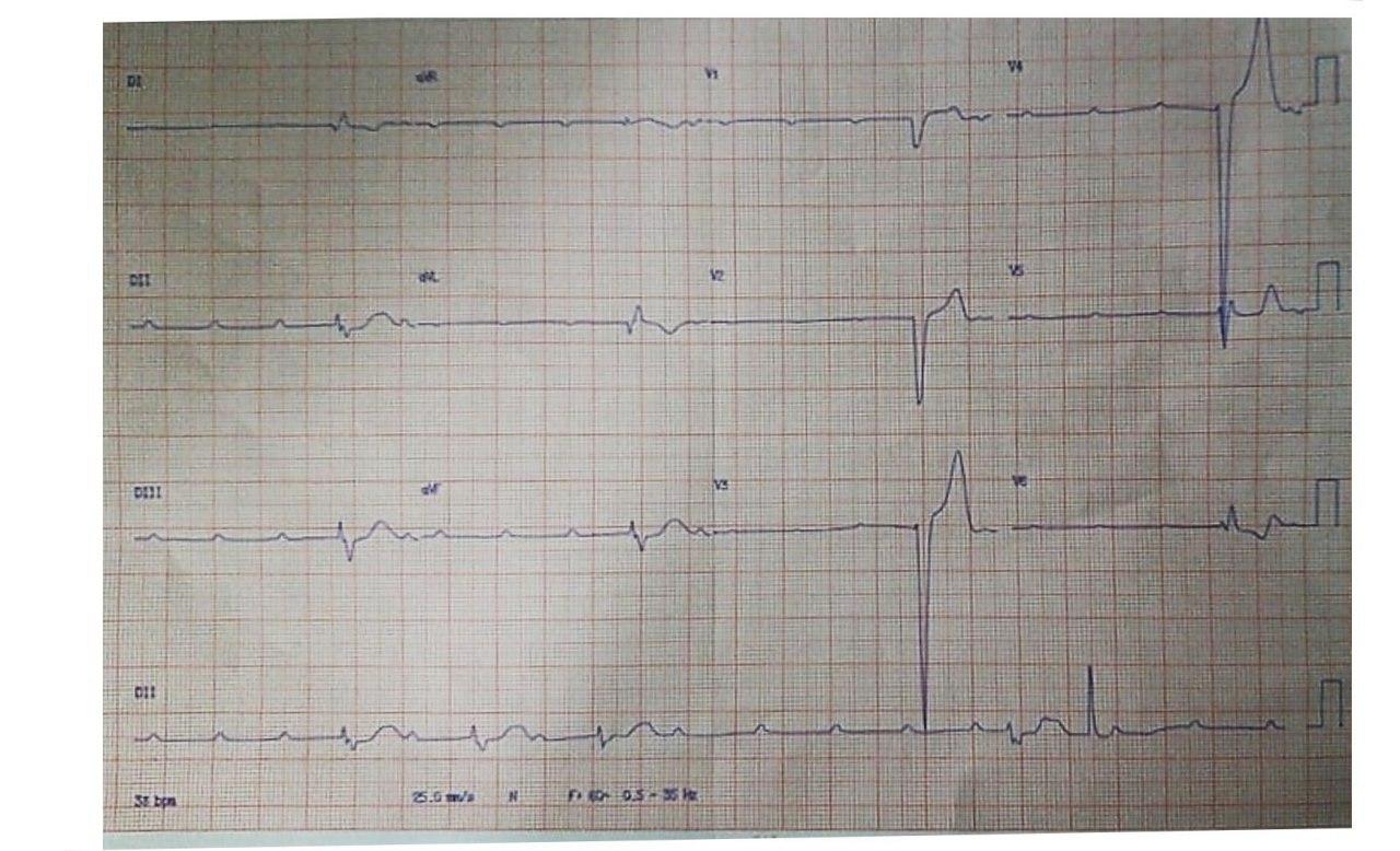 Varón de 18 años que presenta síncope y convulsiones con antecedente cercano de episodio febril y tos cuyo ECG muestra BAVC que se resuelve espontáneamente y leve aumento de troponina en contexto de miocarditis aguda