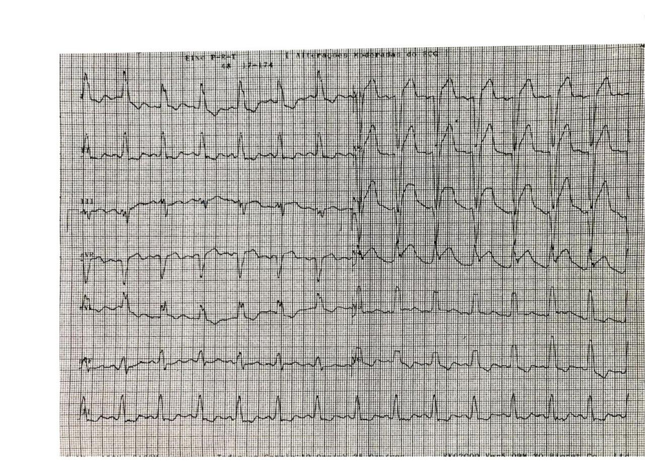Paciente masculino de 64 años con factores de riesgo y angor prolongado por SCA con presencia de BCRI, signo de Sgarbossa + por compromiso de la DA proximal