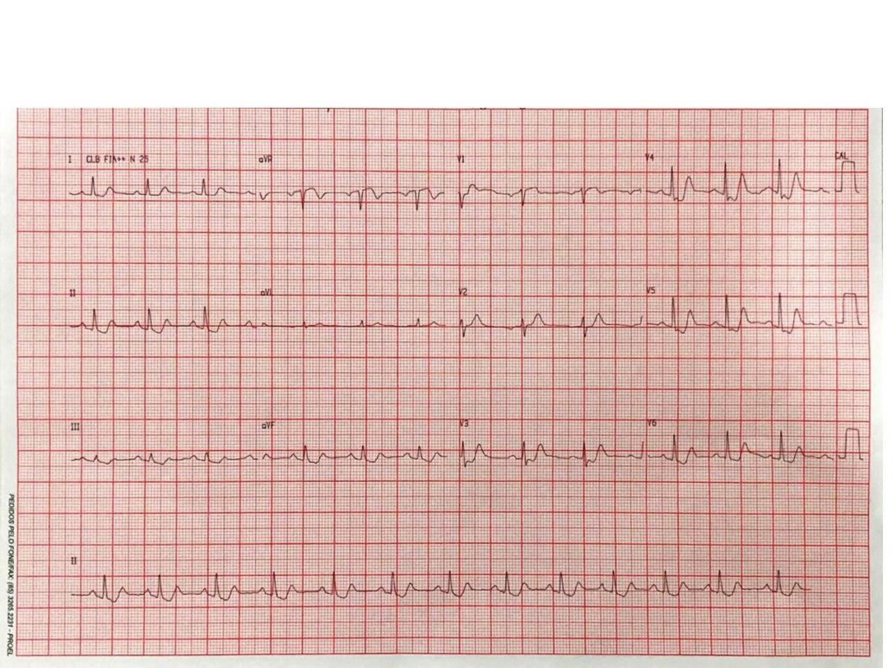 Mujer de 62 años que presenta episodio de angor prolongado por SCA que presenta enfermedad de tres vasos siendo la DA la arteria culpable