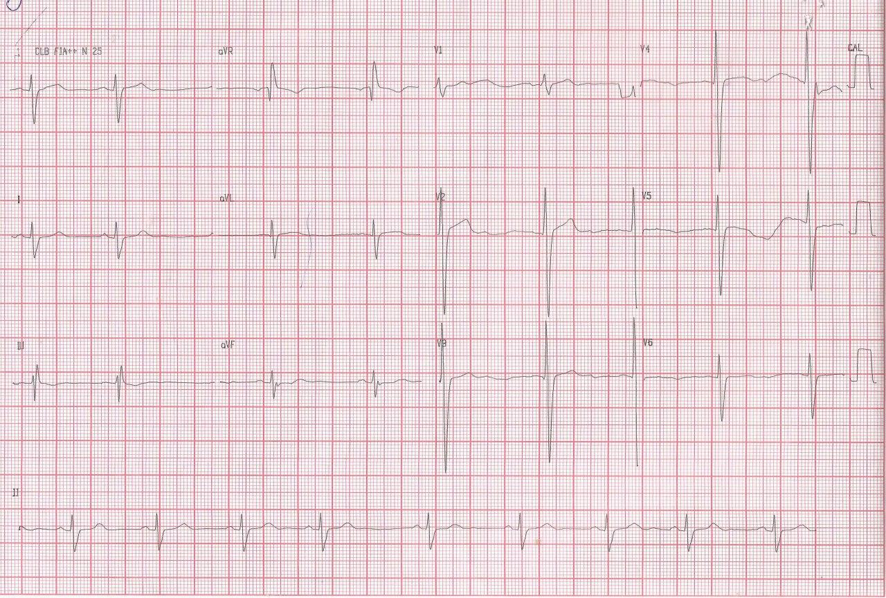 Paciente masculino hipertenso de 43 años que presenta angor y disnea de reciente comienzo con antecedente familiar de hermana de 47 años con MS que presenta miocardiopatía hipertrófica asimétrica obstructiva