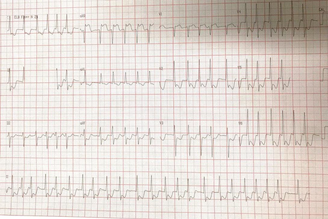 Mujer de 71 años con angor prolongado e inestabilidad hemodinámica que presenta lesión de TCI y fibrilación auricular