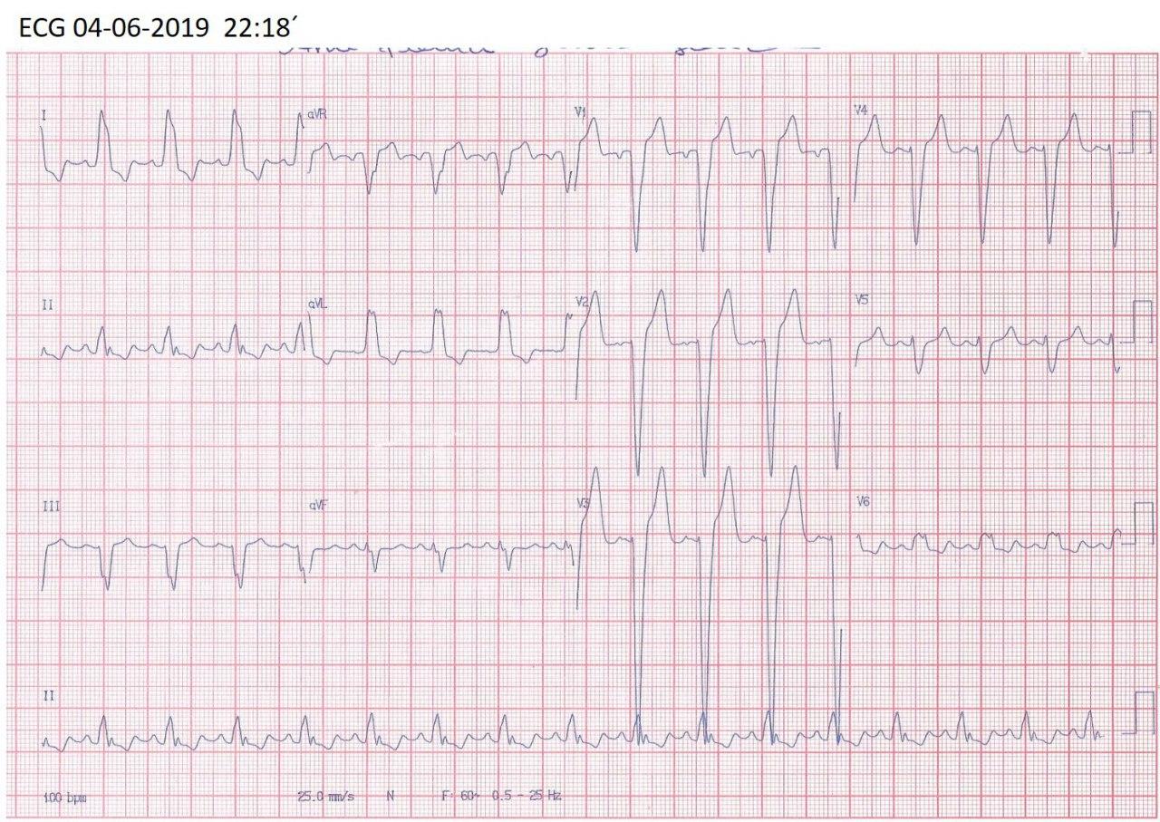 Mujer de 20 años portadora de miocardiopatía dilatada de etiología desconocida que cursa con disnea progresiva y fiebre por infección pulmonar sobreagregada mostrando ondas T negativas por memoria cardíaca post BCRI en fase 3