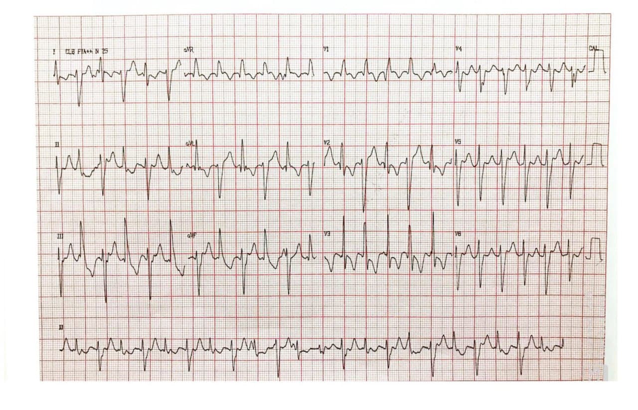 Niña de 15 años, autista con deterioro cognitivo que presenta episodios sincopales en quién se constata taquicardia ventricular bidireccional y miocardio no compactado