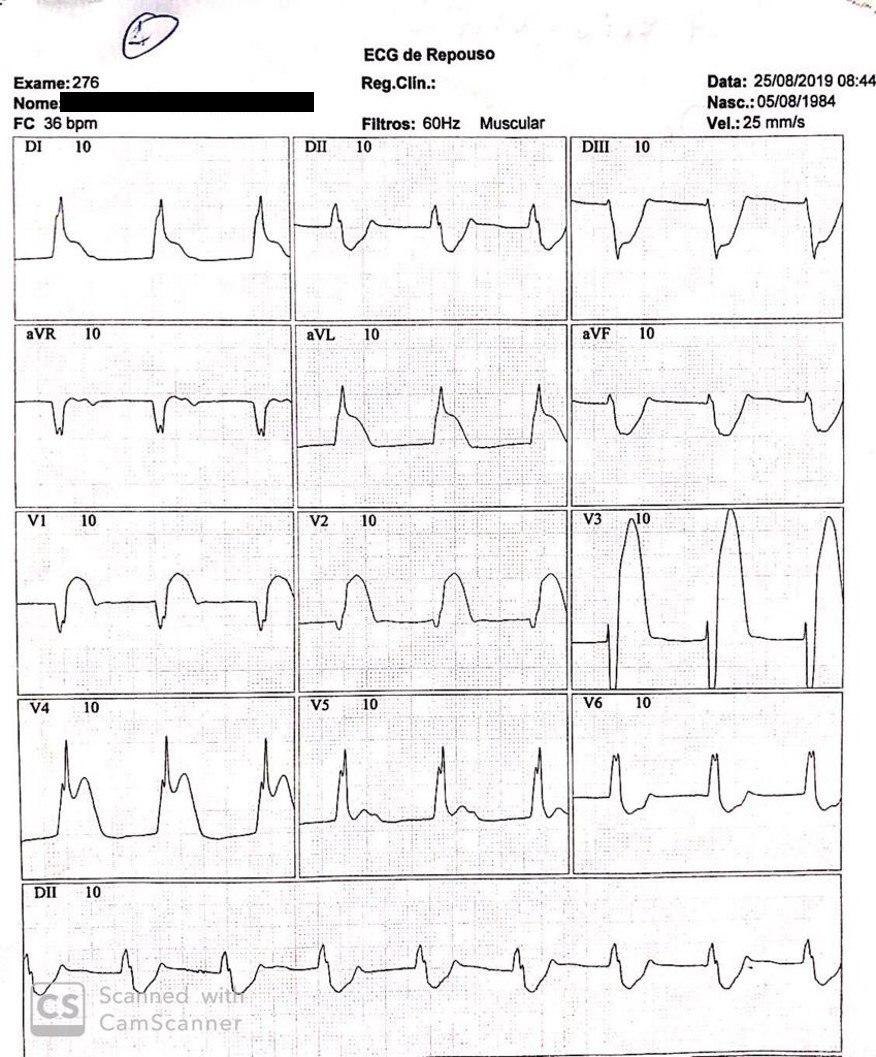 ECGs con y sin angor de paciente de 46 años con espasmo coronario en presencia de síndrome de repolarización precoz
