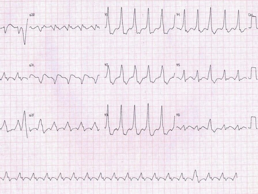 Paciente masculino de 37 años con palpitaciones por presencia de AA 2:1 que pasa a conducción 1:1 en contexto de WPW por vía anómala lateral izquierda