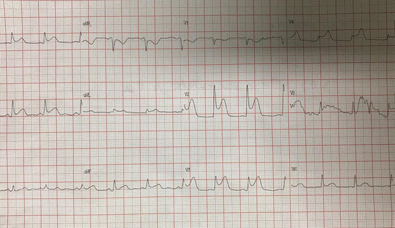 Hombre de 54 años con angor prolongado debido a SCA por compromiso de tercio medio de la arteria DA la cuál es angioplastiada