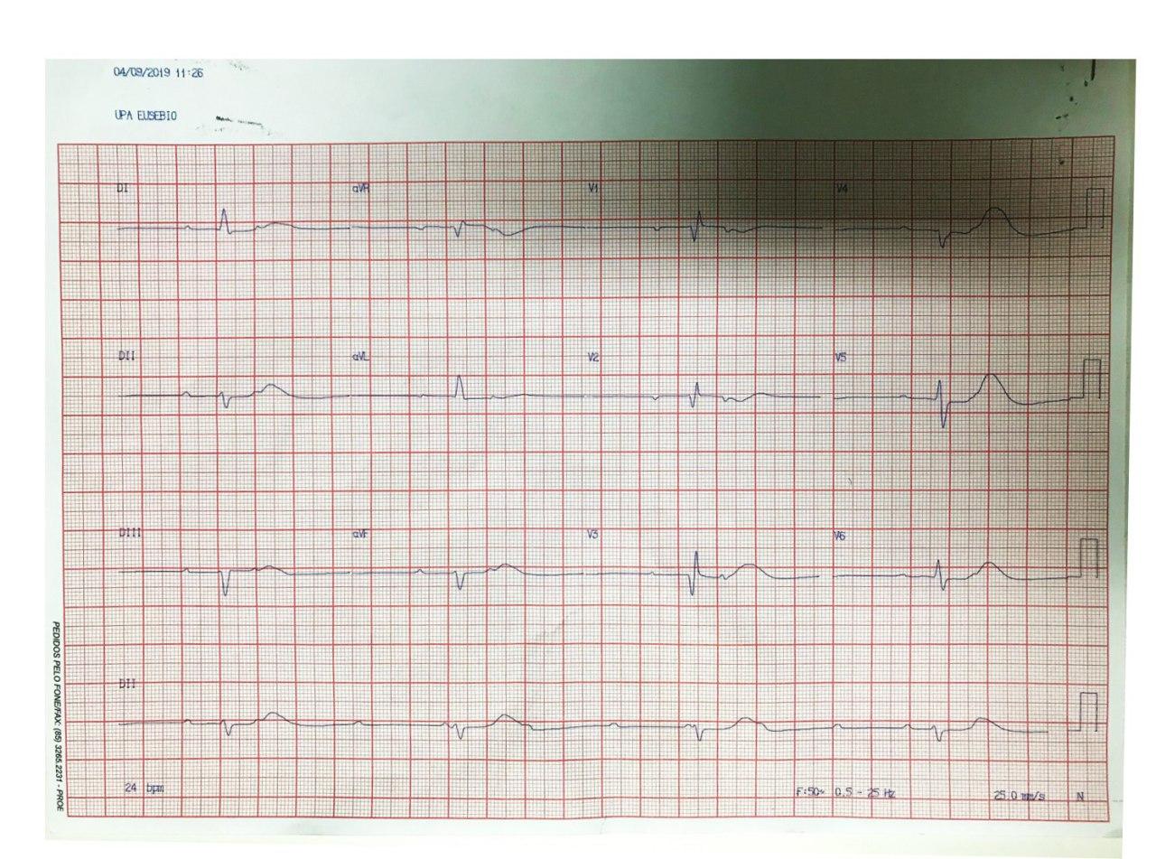 Paciente de 71 años, hipertenso que presenta episodios sincopales por presencia de BAV de alto grado generado en estenosis aórtica calcificada que determina Enfermedad de Lev