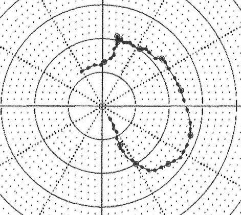 Mujer con CCG normal que presenta palpitaciones en quién se constata BIA-A