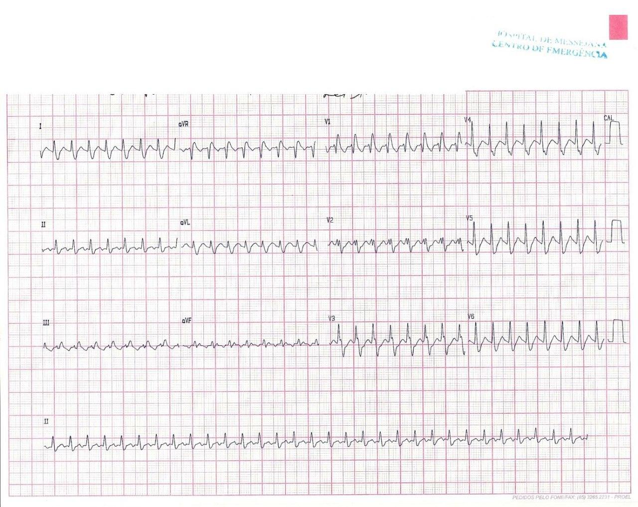 Hombre de 31 años  con palpitaciones originadas en aleteo auricular con aberrancia