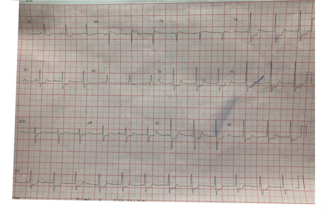 Paciente masculino de 61 años que presenta episodio de angor en el que se constata lesión de TCI