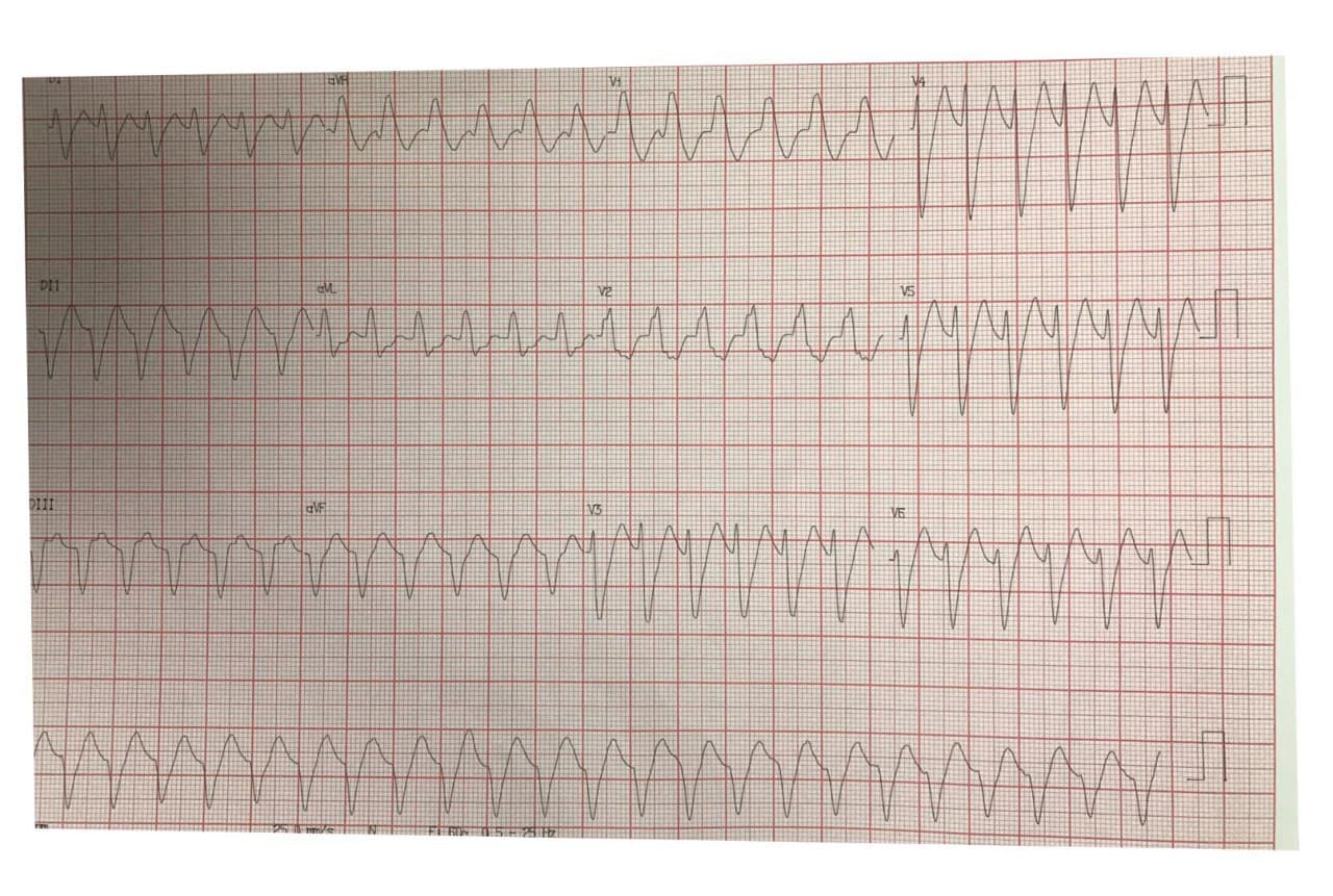 Hombre de 62 años hipertenso con palpitaciones por presencia de TV de etiología no aclarada