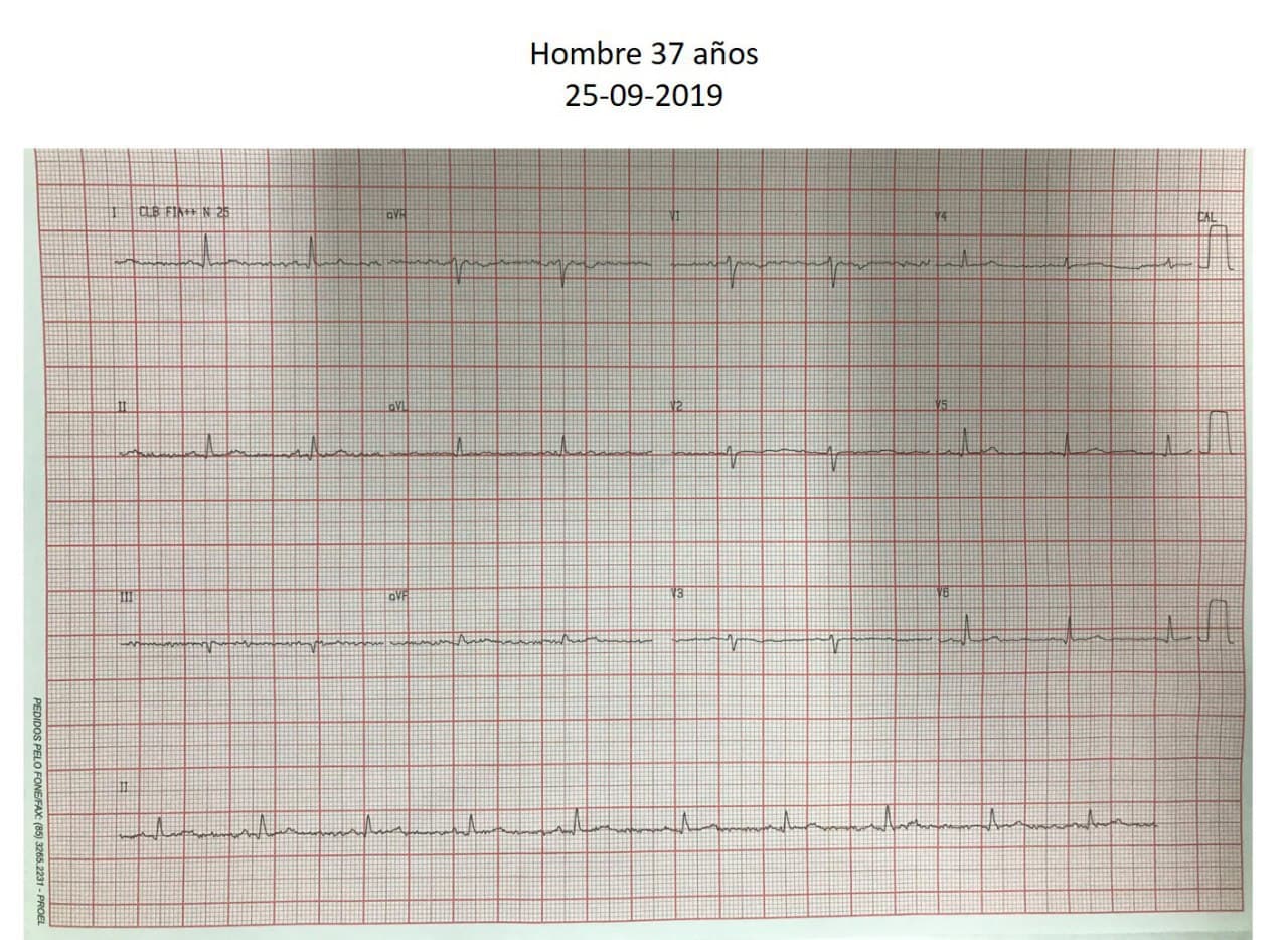 Paciente masculino de 37 años con dolor pleurítico y disnea por presencia de gran derrame plero-pericárdico serohemético de etiología en estudio