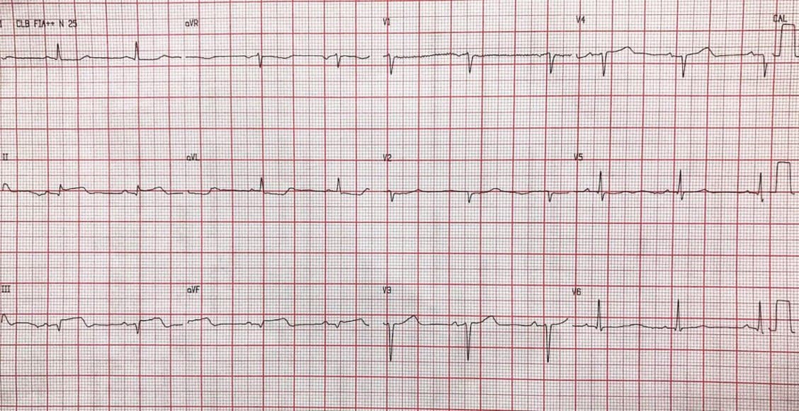 Paciente masculino de 70 años con factores de riesgo que presenta episodio de angor prolongado con onda T plus minus en cara inferior, expresión de trombo activo que ocluye totalmente la CD en su origen