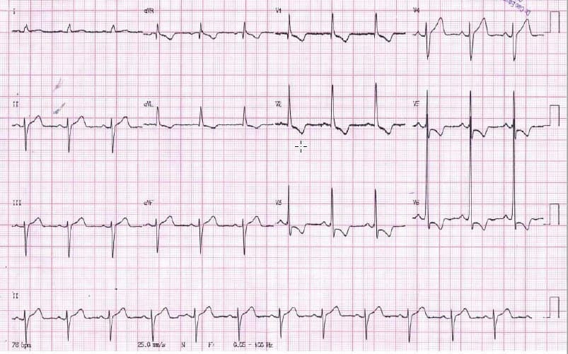 Paciente hipertenso y diabético con episodio de angor durante el cual se observa presencia de HbAI y fuerzas anteriores prominentes, imágenes que desaparecen al cabo de 15 minutos cuando alivia el dolor lo que establece la sospecha de espasmo de CD que se halla ocluída en un 40%