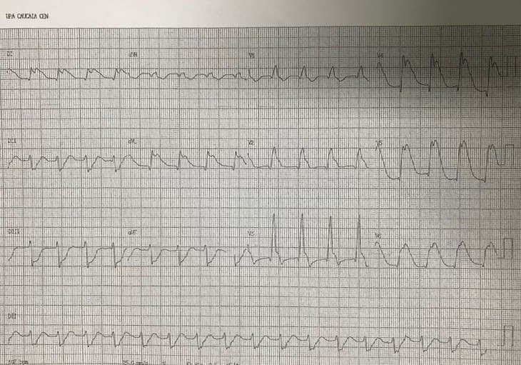 Paciente de 70 años que presenta dolor epigástrico y vómitos seguidos de FV refractaria que logra revertirse después de numerosos choques y que presenta lesión proximal de la DA detrminante de la onda lambda que se observa