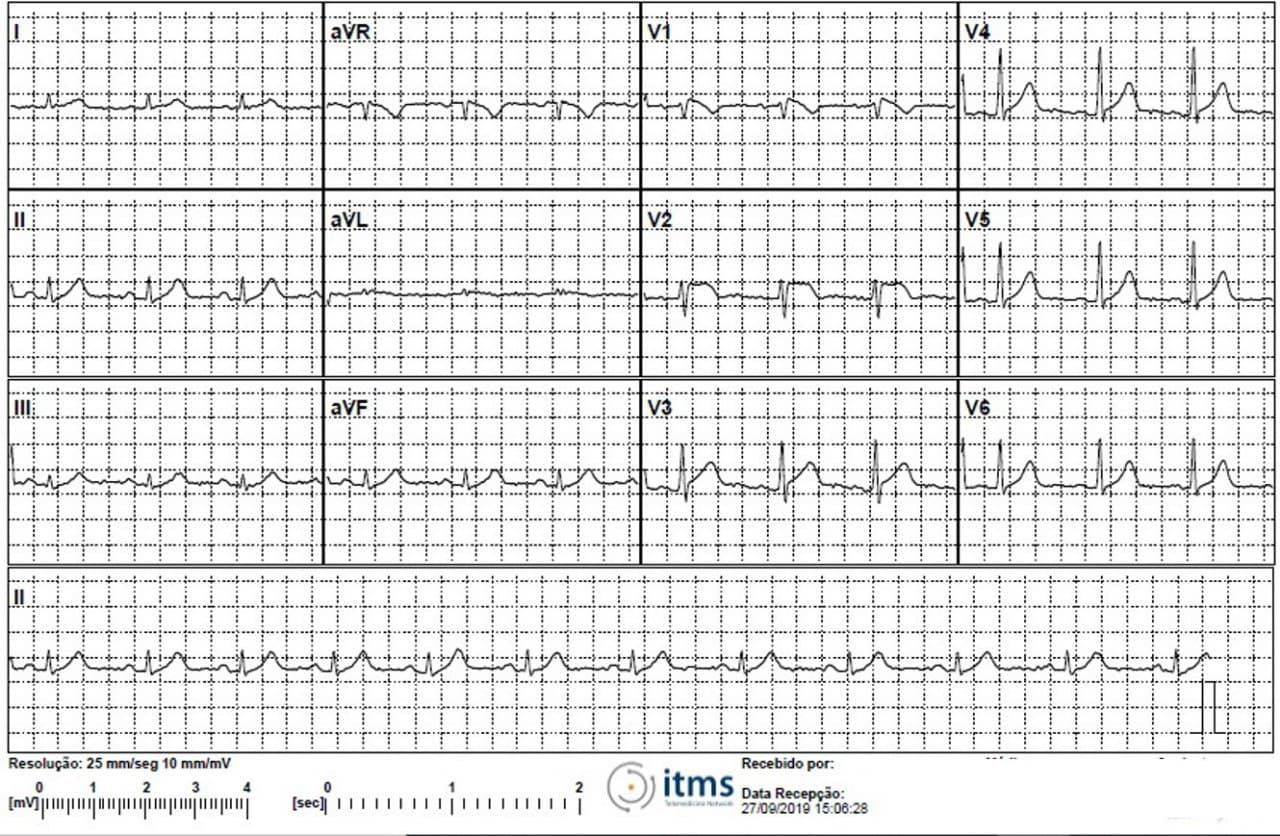 Paciente masculino de 46 años que presenta precordialgia atípica cuyo ECG se interpreta erróneamente como SCA pero que en realidad es una fenocopia de Brugada