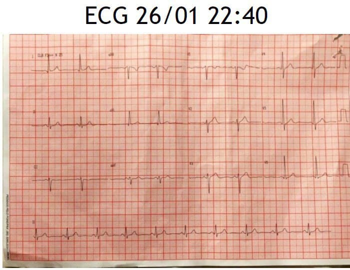 Paciente masculino de 54 años, hipertenso que presenta episodio de angor mientras jugaba fútbol debido a lesión con trombo de la DA