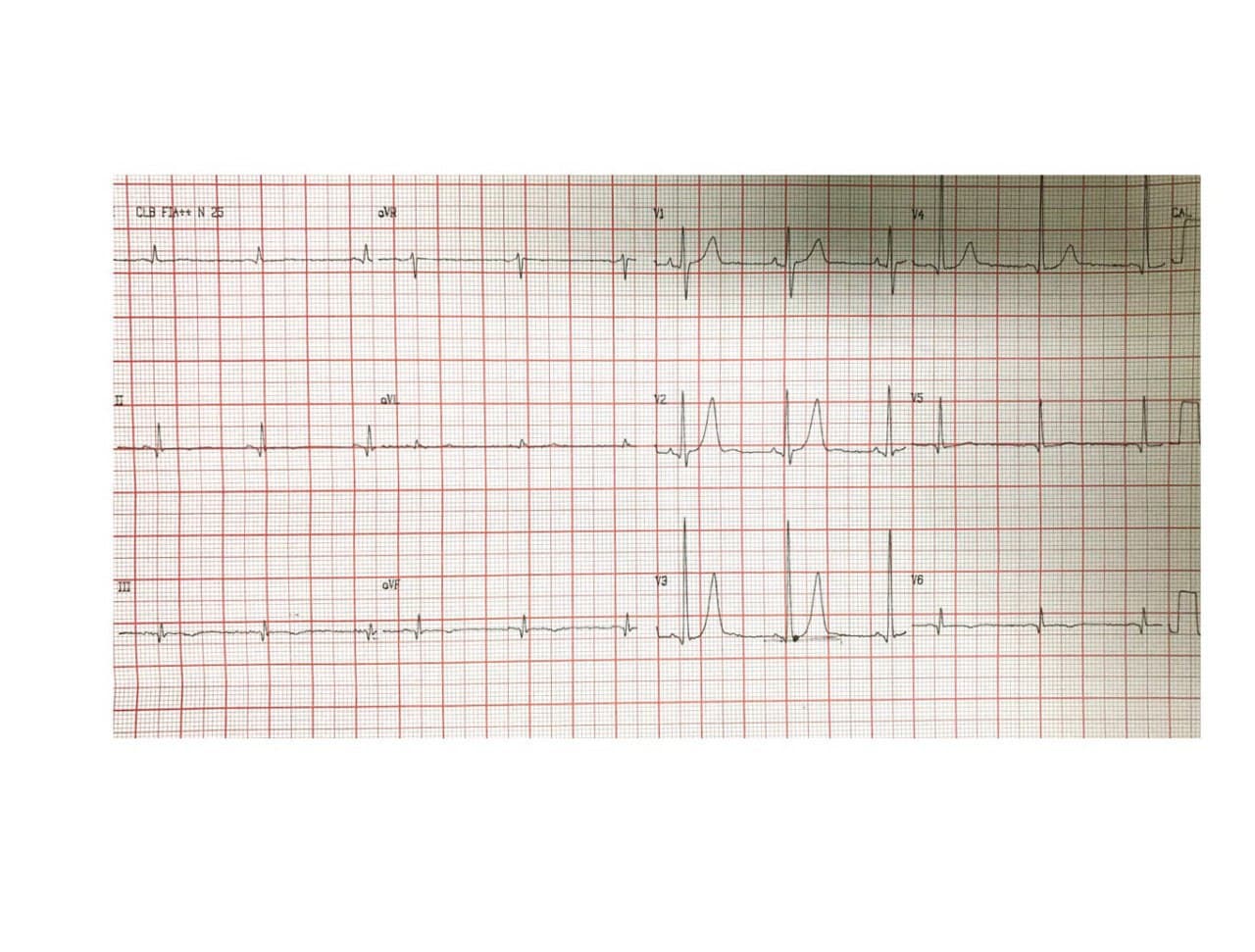 Paciente masculino de 58 años con antecedente de haber cursado un mes antes un IAM ínferolateral por compromiso de la Cx