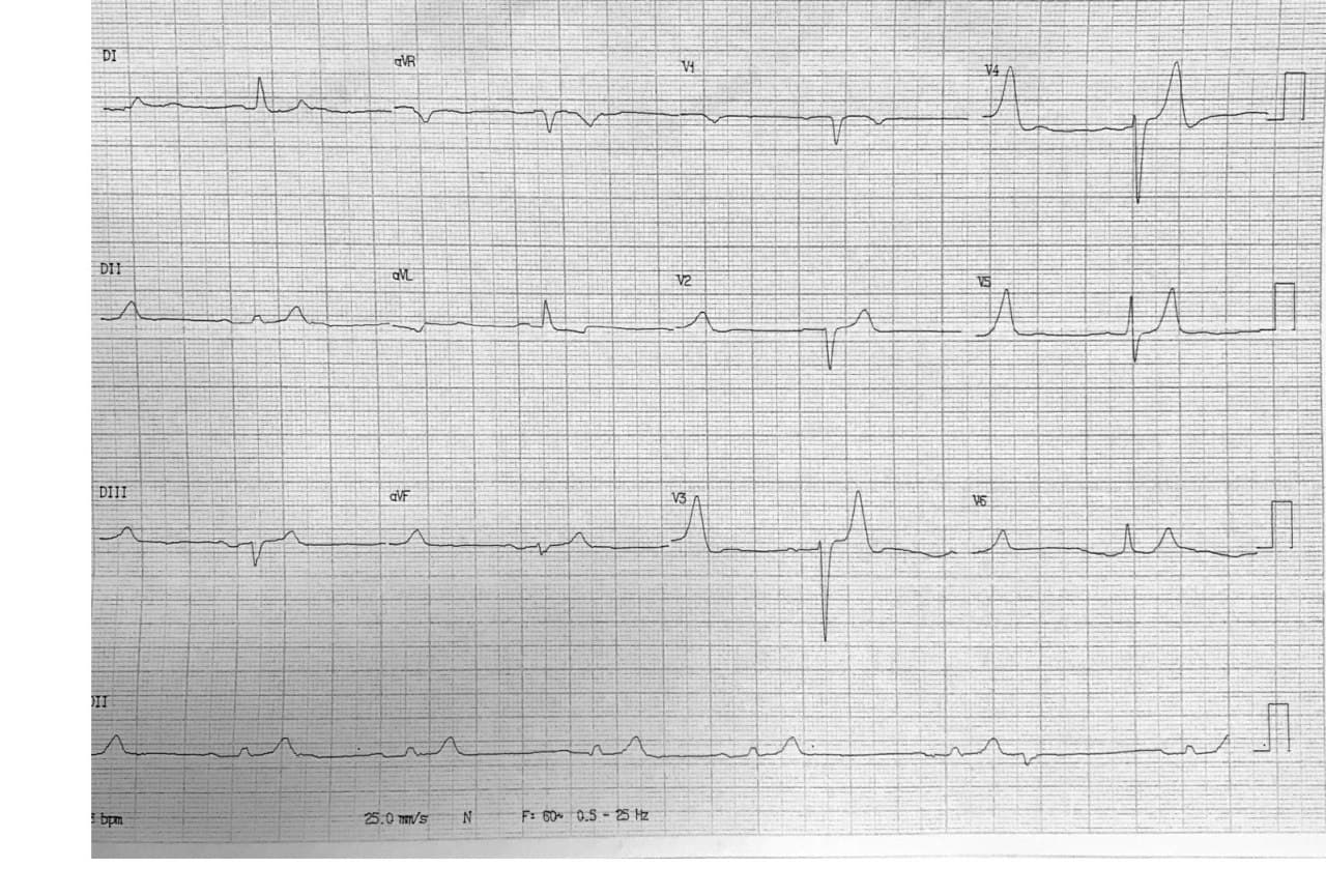 Paciente masculino de 86 años que refiere malestar general, edemas en MMII, mareos e hipotensión que presenta urea y creatinina elevadas e hiperpotasemia severa