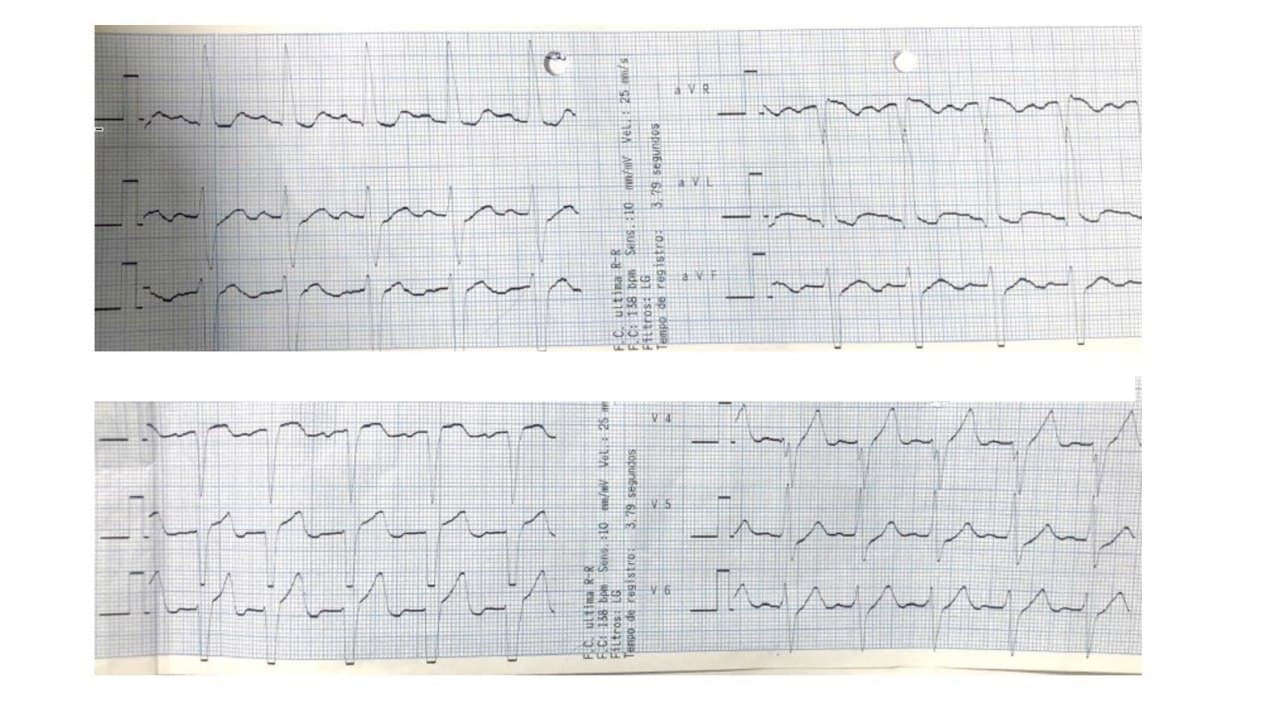 Paciente masculino de 47 años derivado de otro Hospital post reversión de taquicardia de QRS ancho cuyo ECG presenta  BIA-A (activación  caudo-cefálica de AI), HbAI tipo IV Rosenbaum  (SIII> 15 mm) asociado a HVI.