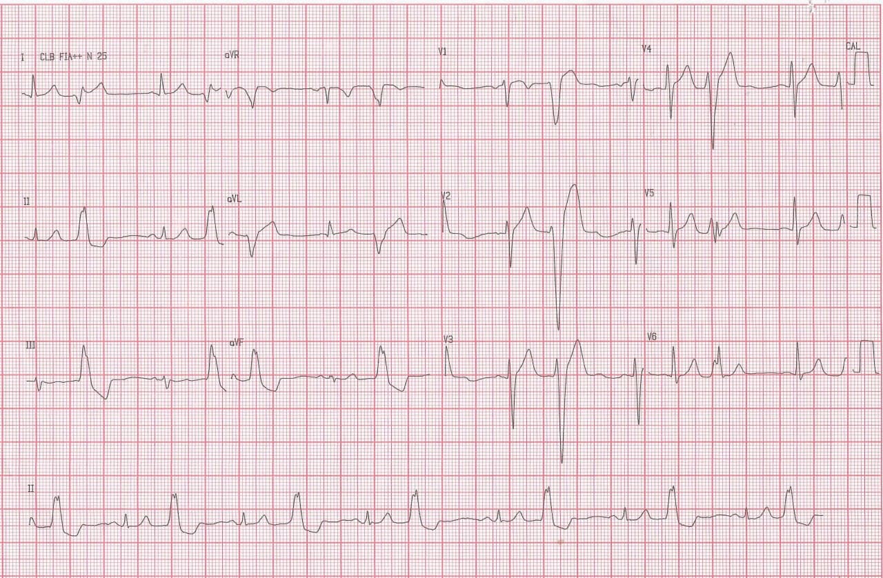 Hombre de 41 años con disnea progresiva, mareos y dos episodios sincopales que presenta EV bigeminada contínua y dilatación de cámaras izquierdas