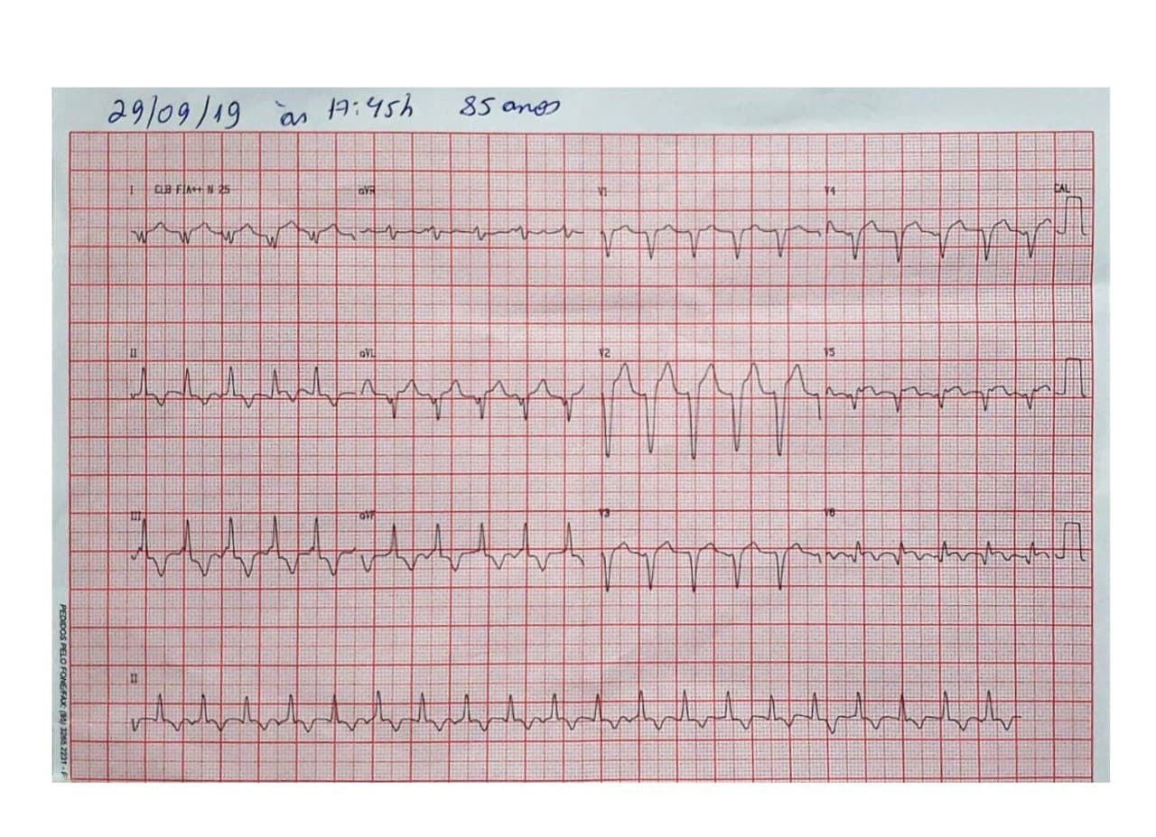 Hombre de 85 años con antecedentes de enfermedad coronaria no revascularizable que presenta angor post prandial y sensación de desvanecimiento debido a presencia de TV originada en cercanías del séptun IV