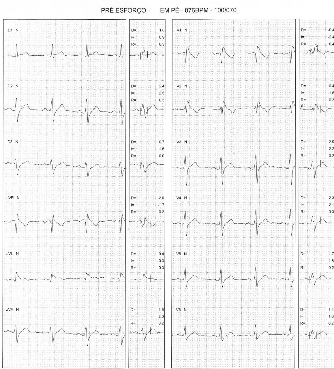 Paciente masculino de 32 años, asintomático, con antecedente de hermano fallecido súbitamente que presenta ECG con patrón de Brugada tipo I que aumenta en el postesfuerzo asociado a patrón de repolarización precoz ínferolateral