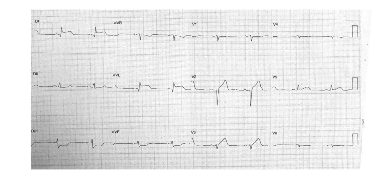 Mujer de 36 años en uso de anticonceptivos que presenta episodio de angor de esfuerzo en quién se constata disección coronaria espontánea