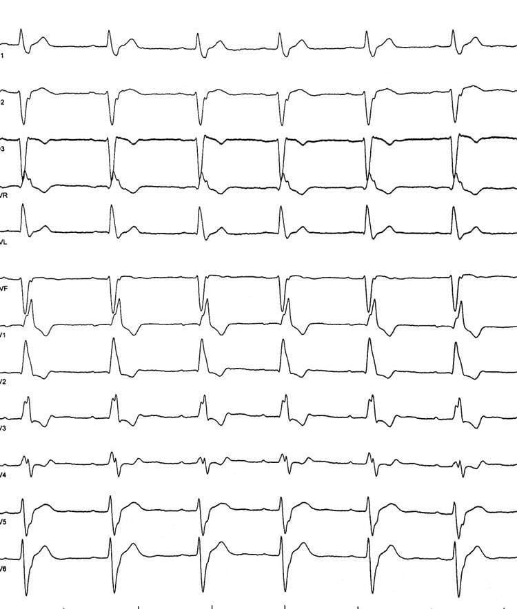 Hombre de 47 años con antecedentes de neurocistercosis que presenta episodio sincopal y en quién se constata bloqueo trifascicular con conducción infrahisiana lenta con HV de casi 100 ms