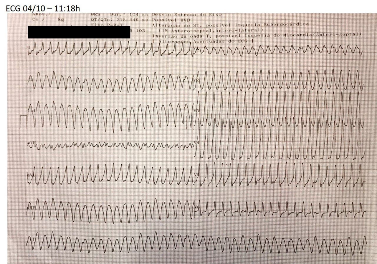 Hombre de 65 años con factores de riesgo que presenta angor de esfuerzo por SCA por oclusión total de CD complicado de TV