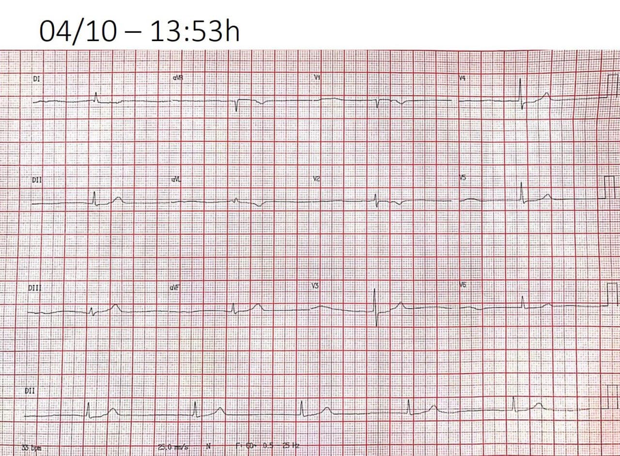 Paciente de 90 años que presenta síncope miccional por bloqueo sinoauricular de tercer grado con un ritmo de la unión AV a una cadencia más lenta