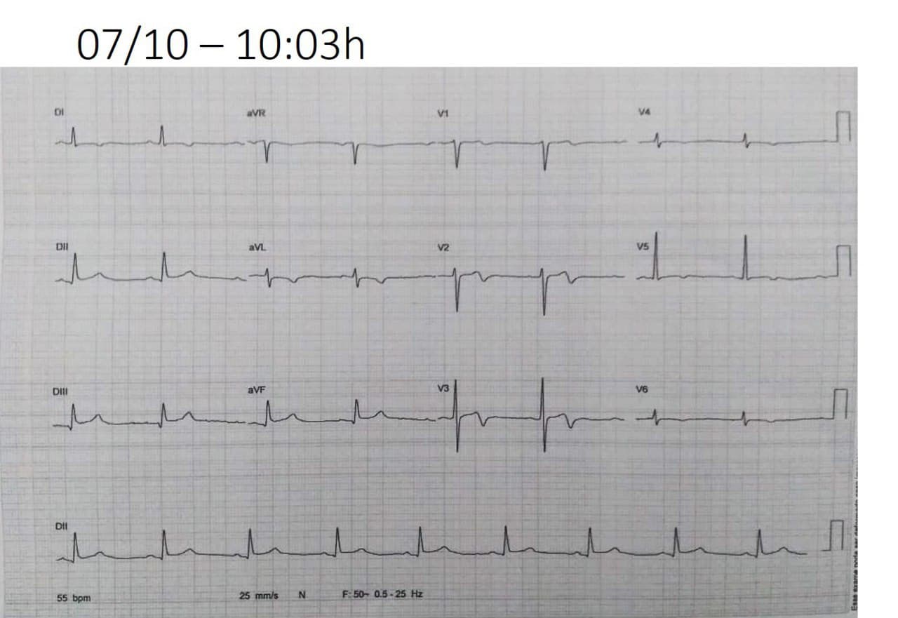 Hombre de 43 años con episodio de angor prolongado que determina imagen ECG de pseudo síndrome de Wellens por oclusión total de la tercera rama marginal de la circunflejo 100% ostial