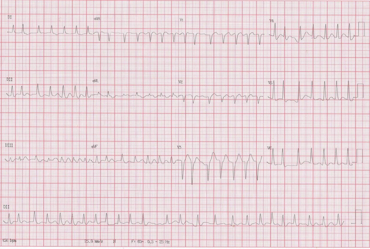 Mujer de 84 años que presenta angor y disnea progresiva hasta EAP que presenta FAARV que requiere CVE poniéndose a posteriori en evidencia alteraciones en la onda P significativas de infarto auricular