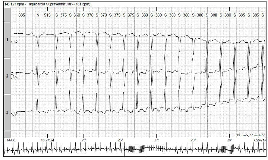 Hombre de 54 años con antecedentes de enfermedad coronaria multivasos que presenta palpitaciones por presencia de vía accesoria mostrando un alargamento significativo del intervalo PR como cambio de la conducción anterógrada de la vía rápida a la vía lenta