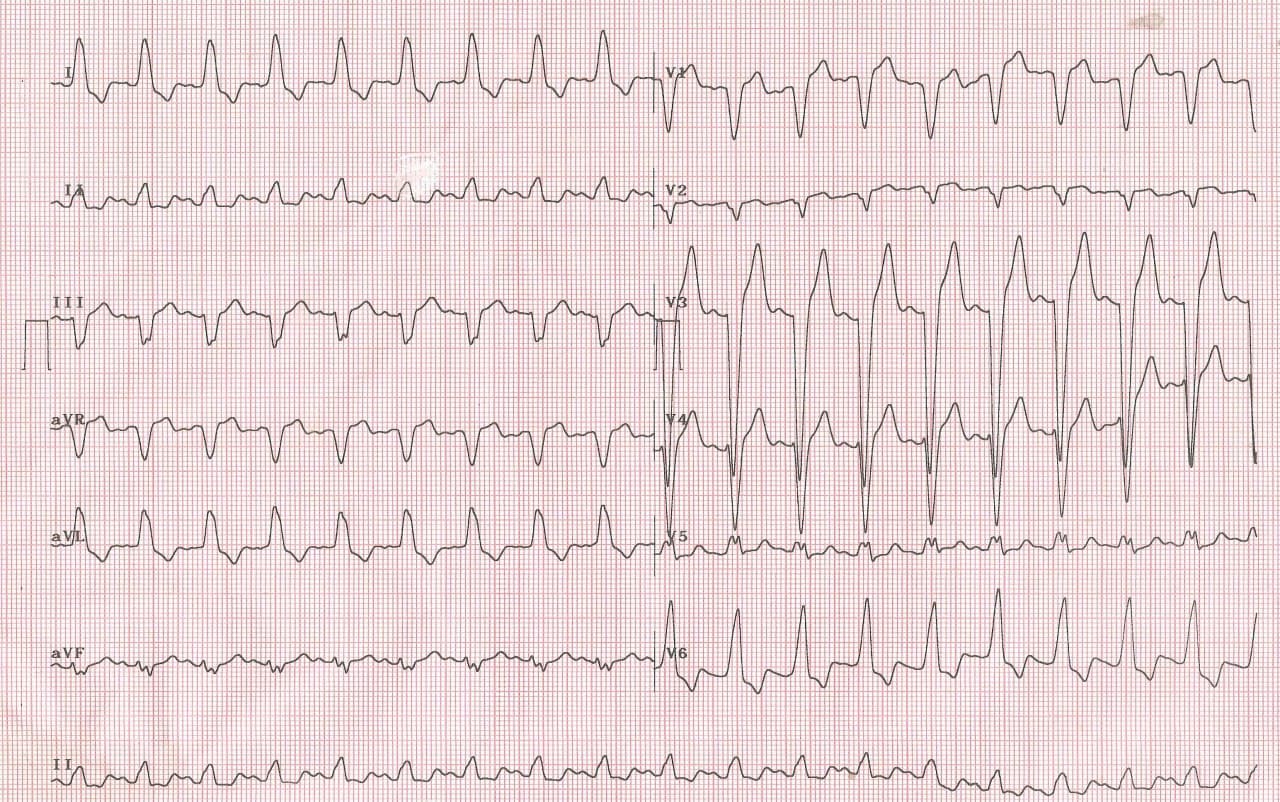 Mujer de 72 años con disnea severa luego de episodio de angor hace 8 días que presenta taquicardia con BCRI, troponina +  y bloqueo de rama bilateral por lesión de DA y evolución al óbito