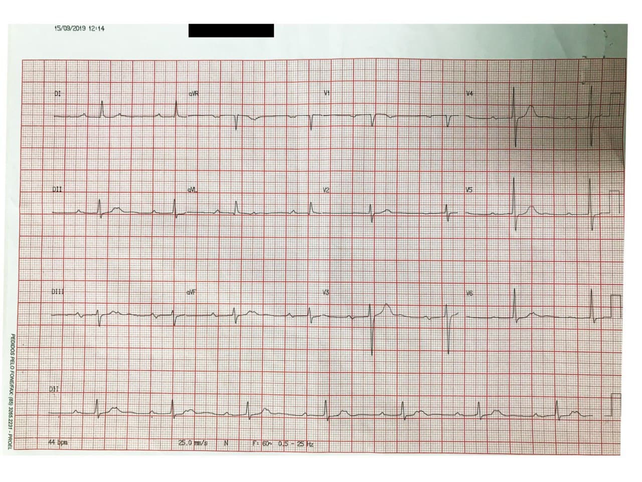 Paciente masculino de 69 años hipertenso y diabético con antecedente de implante de stent a la DA que presenta mareos atribuibles a un BAV 2:1