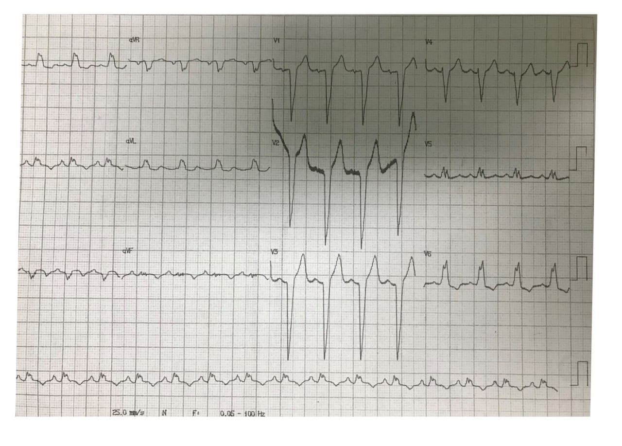 Hombre de 63 años con múltiples factores de riesgo que presenta angina inestable, con BCRI y hallago de lesión distal del TCI del 90%. 80% del ramo marginal de la CD, 90% de la DA proximal y 70% de la CX