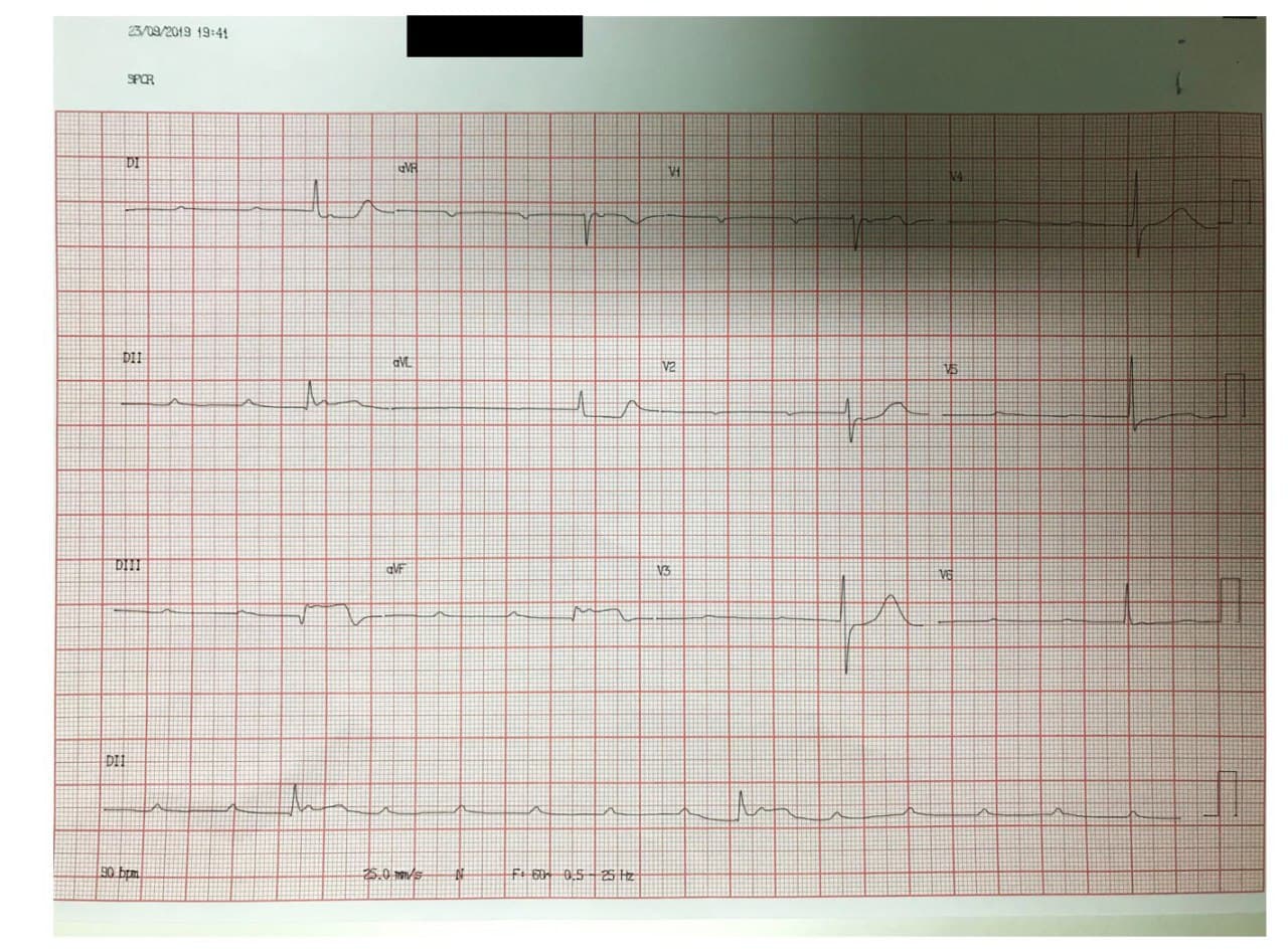 Hombre de 83 años HTA y DBT que presenta cuadro de angor prolongado y síncope por cursar SCA con BAVC por compromiso de la arteria del nódulo AV rama de la CD