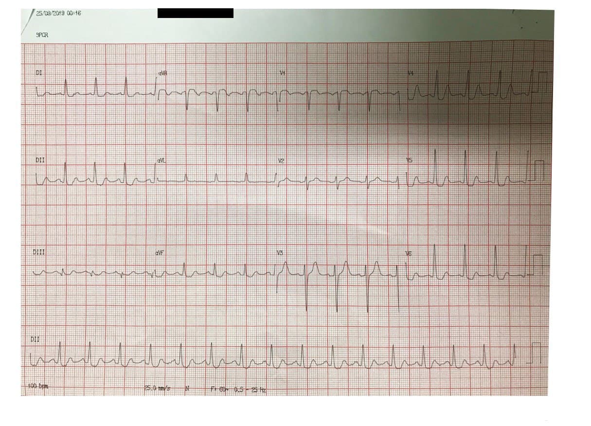 Mujer de 74 años, hipertensa tratada irregularmente, con angina de reciente comienzo y episodio actual de reposo, por enfermedad de tres vasos severa