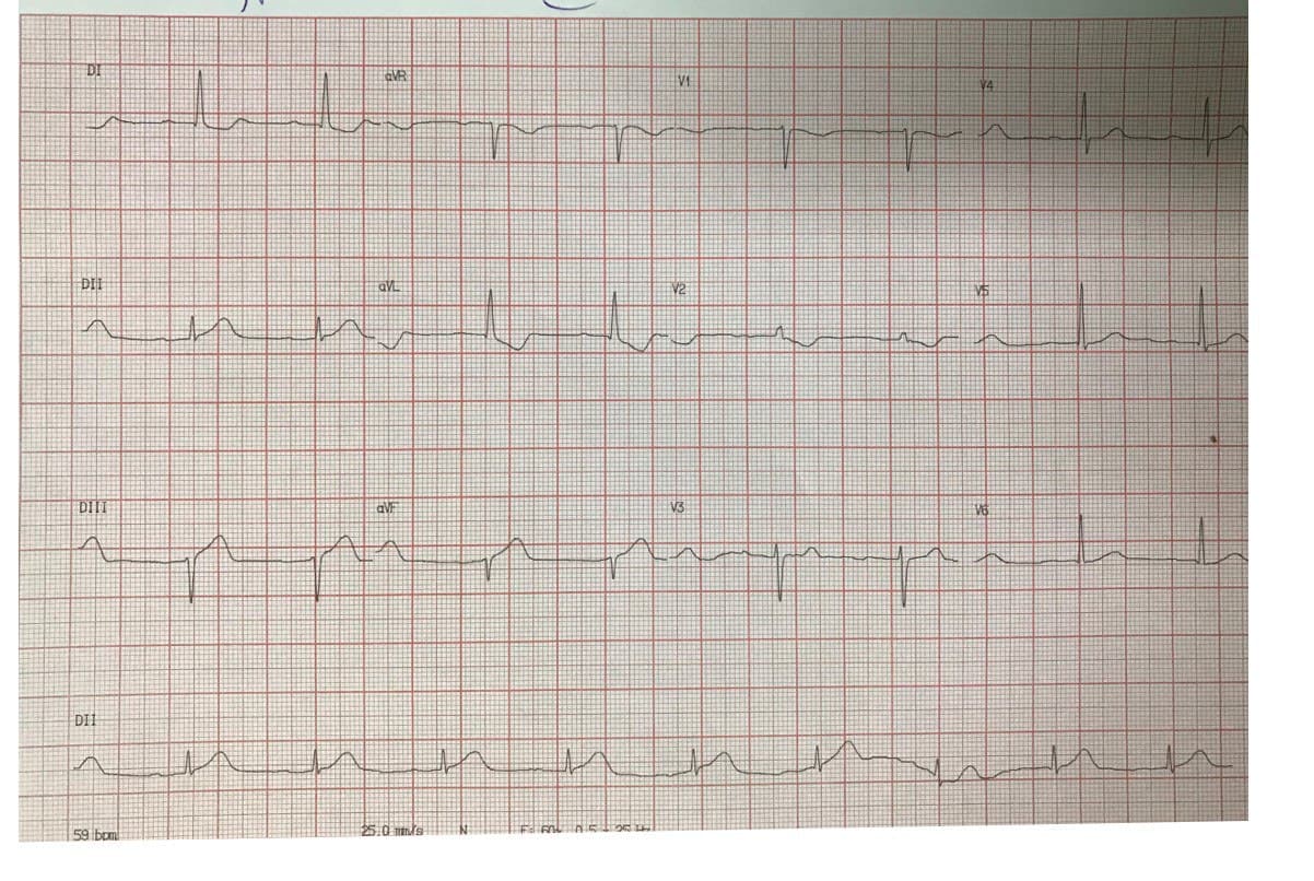 Hombre de 71 años hipertenso que cursa SCA con mínima elevación del segmento ST en DIII en quién la imagen en espejo en aVL es de fundamental ayuda para localizar el compromiso de la CD