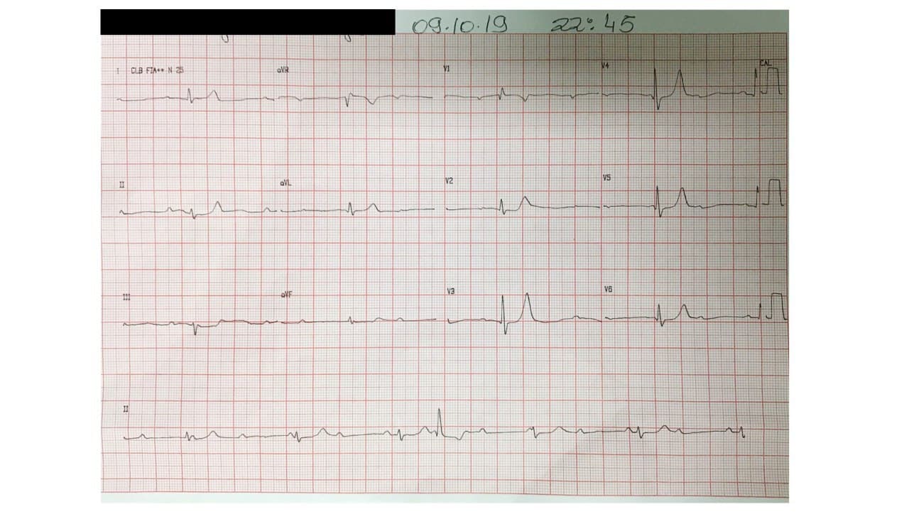 Mujer de 74 años hipertensa que presenta BAVC por severa calcificación del anillo mitral con penetración hasta el Haz de His
