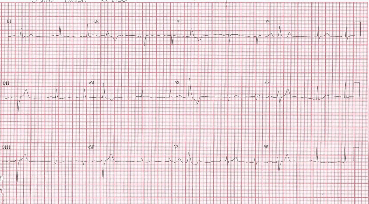 Hombre de 74 años portador de insuficiencia renal crónica con angina inestable refractaria con antecedente de implante de stent a Cx, por compromiso suboclusivo actual de 1º diagonal