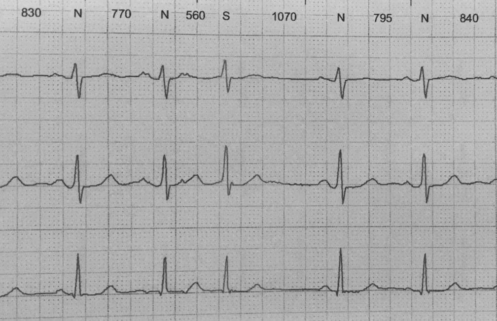 Paciente portador de doble vía nodal rápido – lenta que desarrolla una taquicardia reentrante nodal en la que las ondas P se inscriben al final del complejo QRS