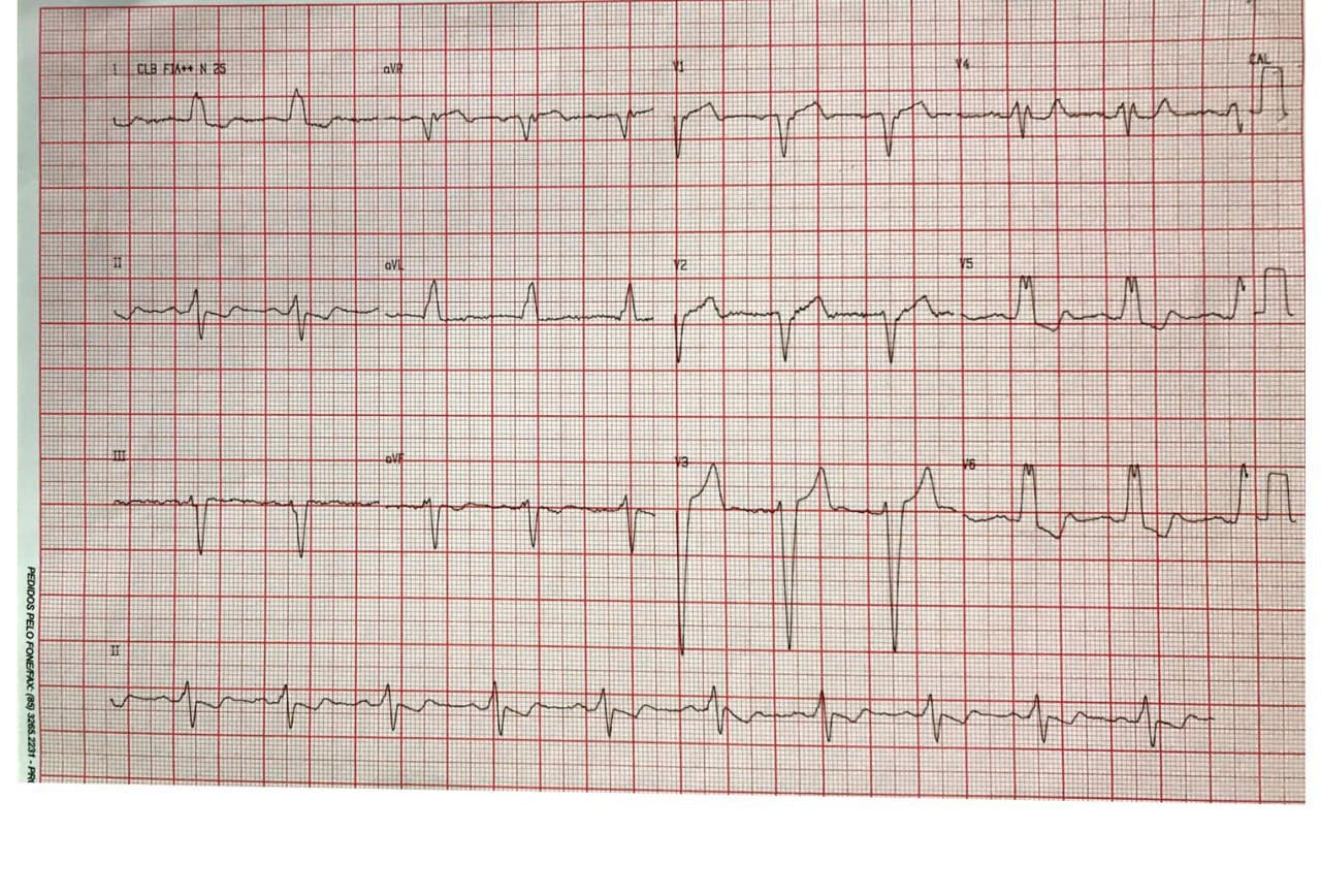 Mujer de 64 años con mareos que presenta avanzado compromiso del sistema de conducción AV en quién se indica TRC + CDI