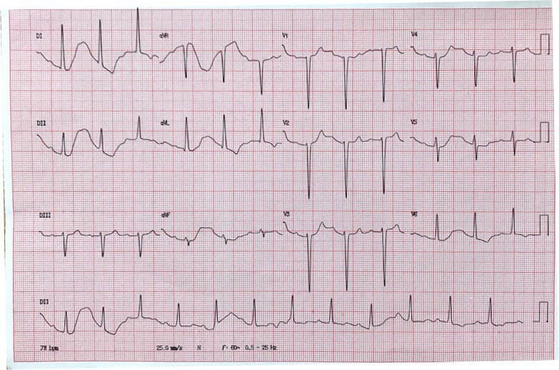 Mujer de 67 años con estenosis aórtica severa en quién se practica TAVI presentando luego BCRI transitorio